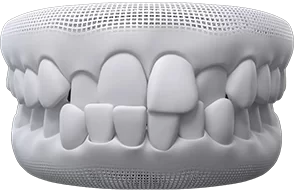 crossbite