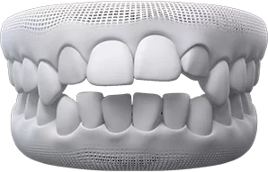 open bite