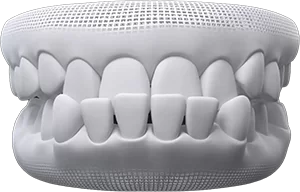 underbite